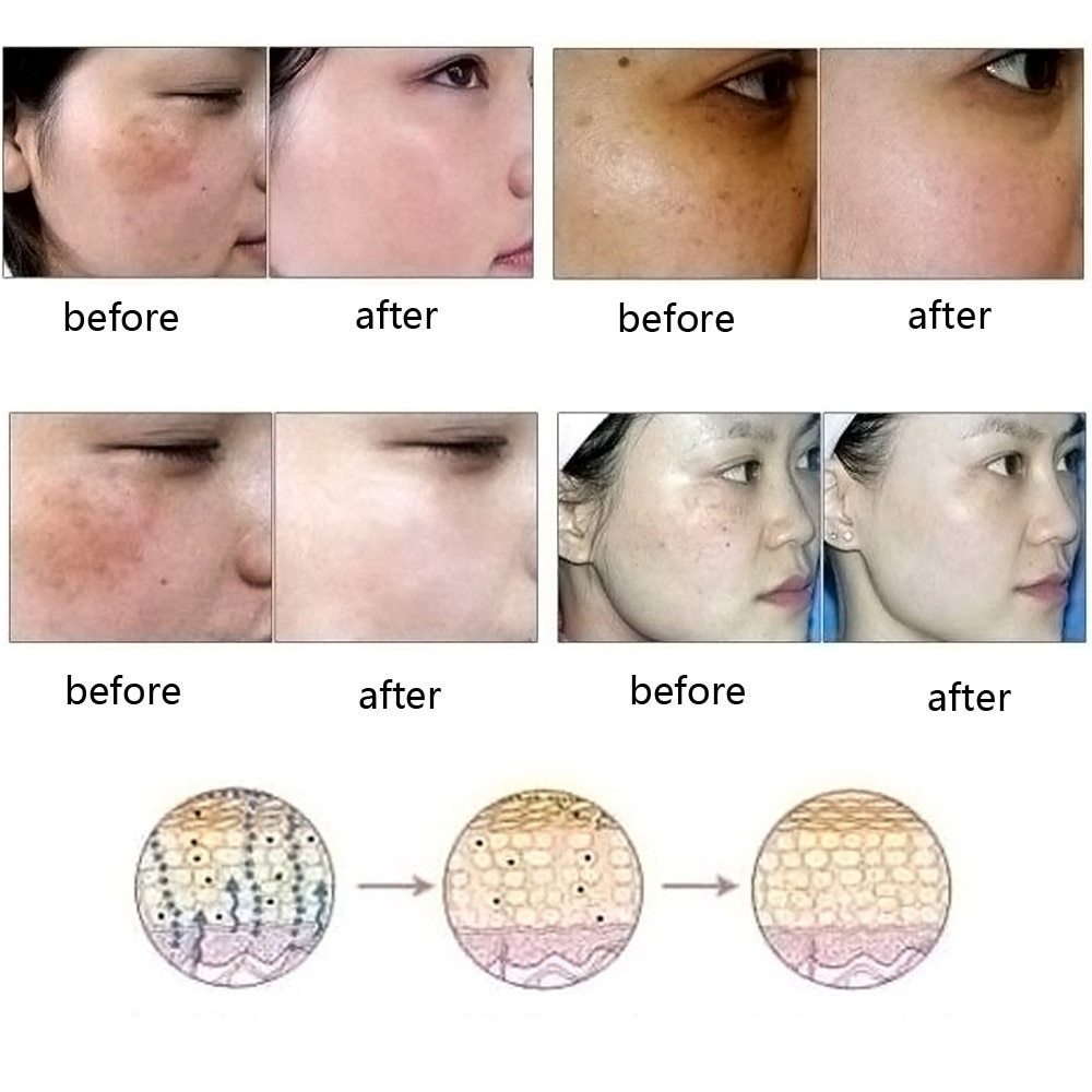 Skin Care Acne Removal Essence oil - Expert Solutions