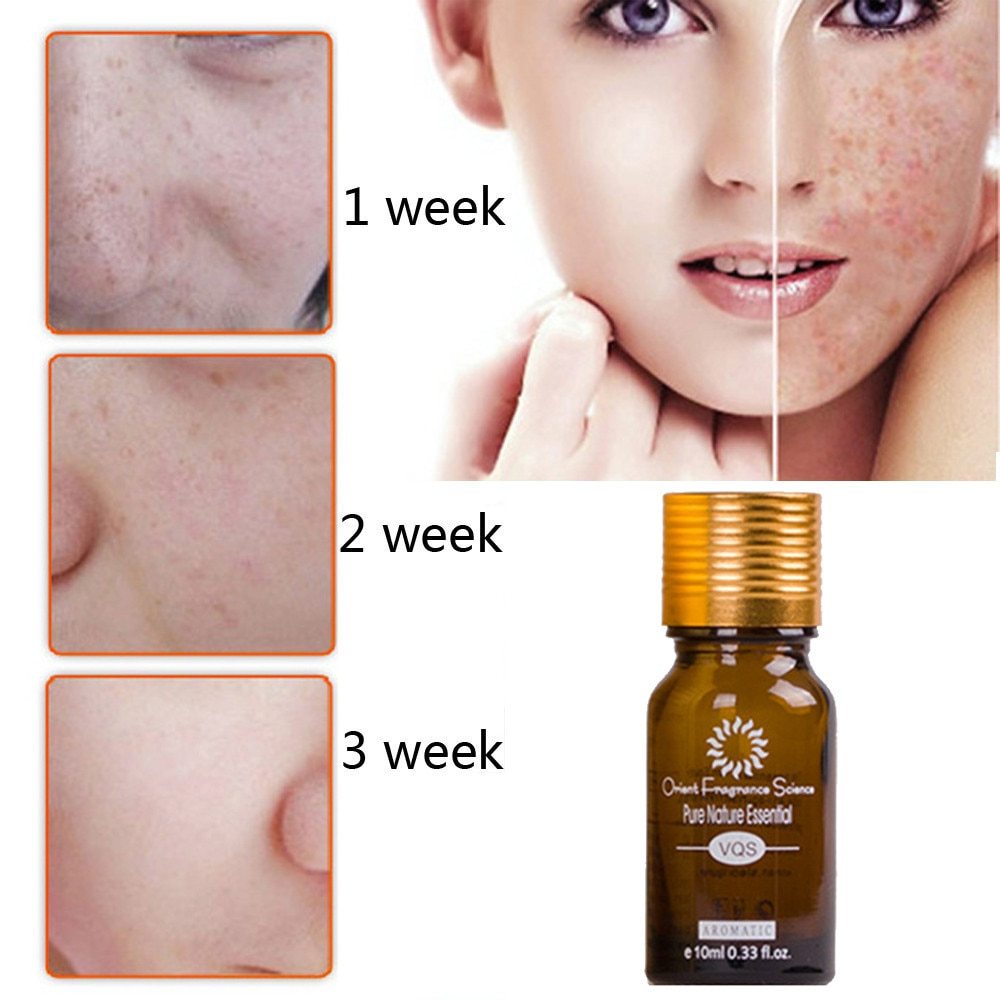 Skin Care Acne Removal Essence oil - Expert Solutions